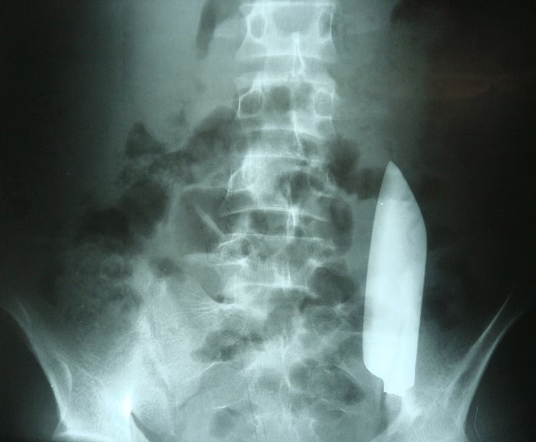 Radiographie montrant une lame flottant dans l'abdomen du patient