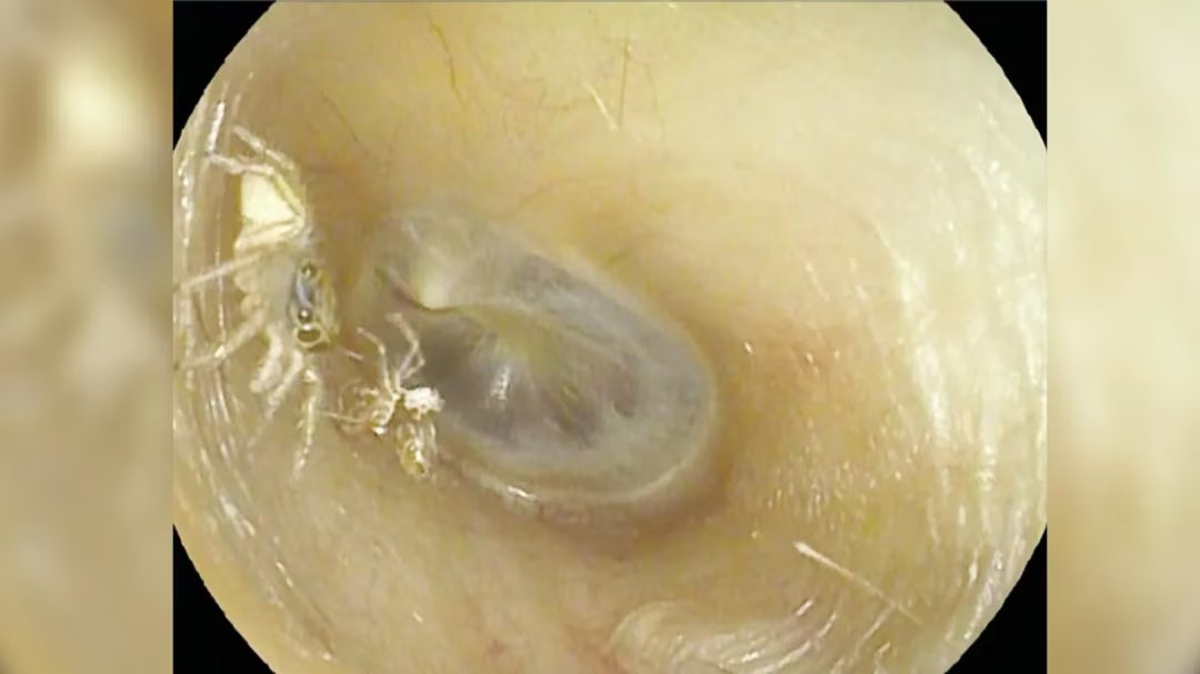 Araignée et exosquelette dans l’oreille